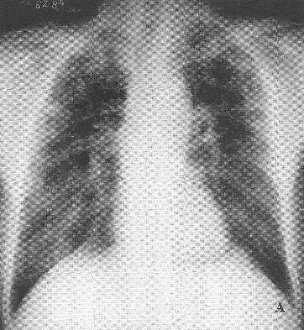 图2—346 进行性系统性硬化症性肺间质病变